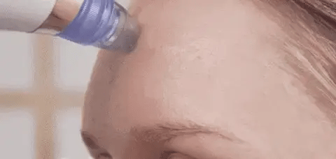 Vacuum Blackhead Remover